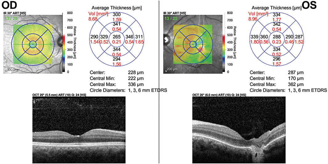 FIGURE 2: OCT showed disruption of the outer retinal layers, Bruch’s membrane, and retinal pigment epithelium (RPE) with extension into the choroidal layers in the right eye. IMAGE COURTESY HEMANG K. PANDYA, MD FACS