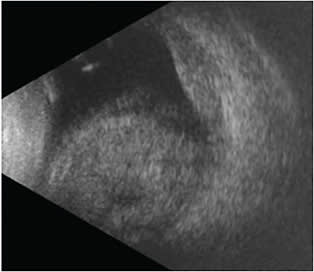 FIGURE 3: B scan of the right eye on presentation showing dense non-kissing choroidal hemorrhages, vitreous hemorrhage, and a flat retina.