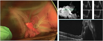 FIGURE 1: Color fundus photo of left eye on presentation showing large non-kissing hemorrhagic choroidals with flat, corrugated retina; OCT 5-line raster scan of left eye on presentation with a flat retina but with choroidal detachment into the macula involving the fovea.