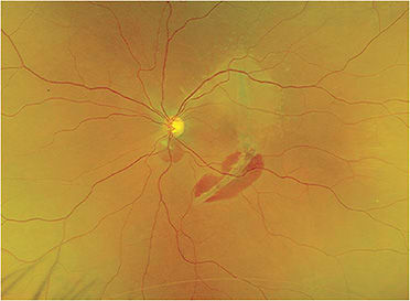 FIGURE 1: Color fundus photography revealed a choroidal rupture with adjacent subretinal hemorrhage in the posterior pole of the left eye.IMAGE COURTESY HEMANG K. PANDYA, MD FACS