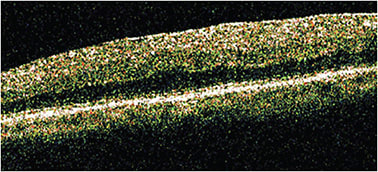 FIGURE 2: Optical coherence tomography image presented by Kim et al. demonstrating an example case in which attenuated IS/OS is present even without significant thickening and internal disorganization. IMAGE COURTESY ZACK OAKEY, MD