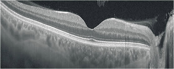 OCT devices are incredibly sensitive and can measure change to a micron.COURTESY DARRIN A. LANDRY, CRA, OCT-C
