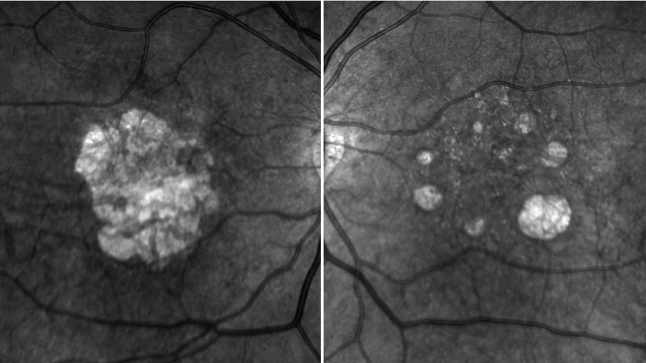 Infrared fundus images in a 61-year-old patient with center-involving GA in the right eye (A) and extra-foveal GA in the left eye (B).