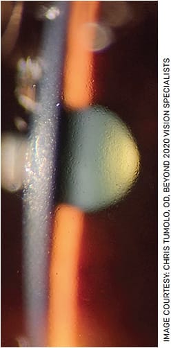 FIGURE 2. Slit lamp color photo of the cornea of a patient illustrating endothelial guttae in Fuchs’ corneal dystrophy.