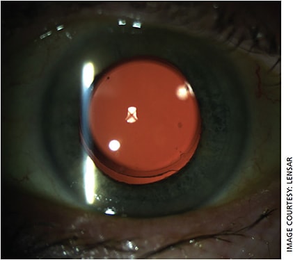 Intelliaxis markings created with the LENSAR Laser System with Streamline IV help surgeons optimize toric IOL alignment.