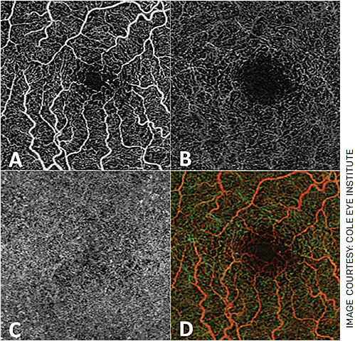 FIGURE 1. OCTA allows for visualization of the superficial capillary layer (A), deep capillary layer (B) and choriocapillaris (C) individually.