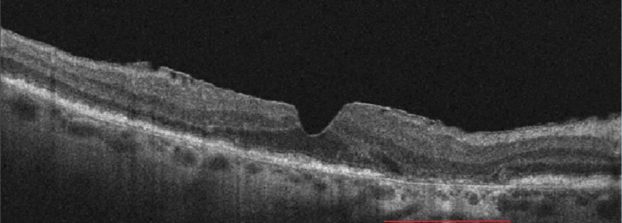Figure 3. Complete RPE and outer retinal atrophy (cRORA) indicated by red line. Note hypertransmission. Imaging via Zeiss Cirrus 5000.