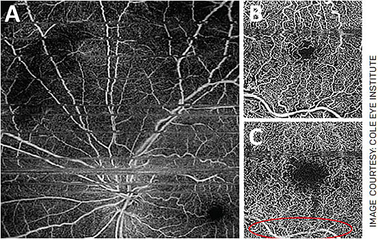 FIGURE 4. Common image artifacts in OCTA include projection artifacts and motion artifacts