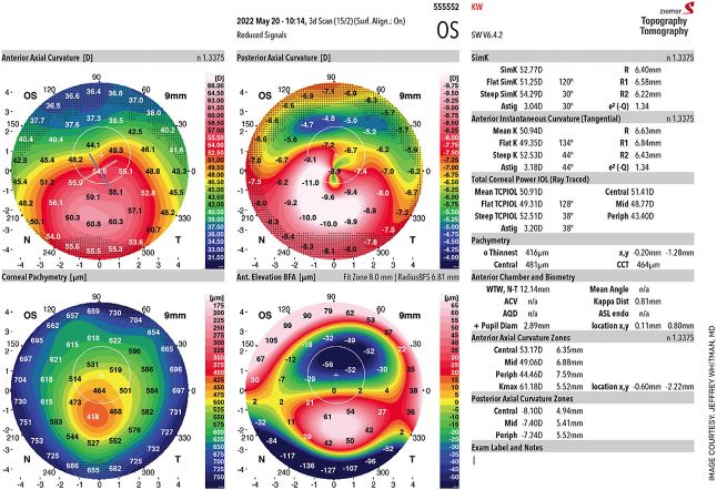 This topography demonstrates classic changes from keratoconus in a 24-year-old male. Note marked steepening and thinning in the inferior temporal area.