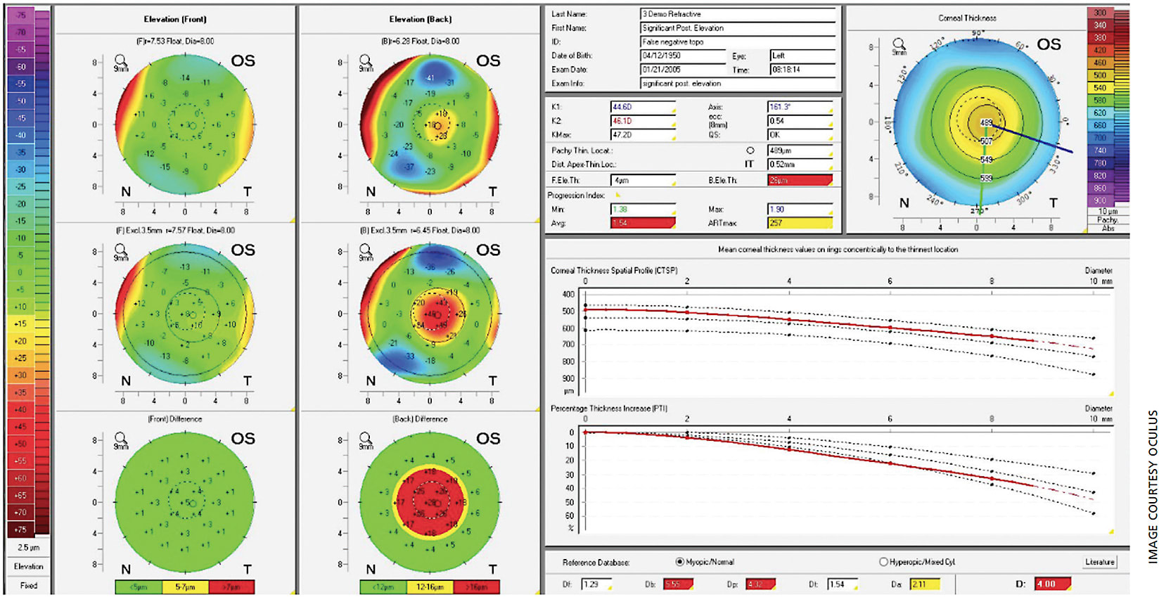 Figure 1. Belin Ambrosio Enhanced Ectasia Display of a left eye with subclinical keratoconus. Anterior (column on left) maps are relatively normal. Posterior maps (second column) show abnormalities, especially the enhanced best fit sphere map showing centrally posterior elevation (red). The percentage thickness increase chart on the bottom right is abnormal, as it deviates outside of the three reference marks.