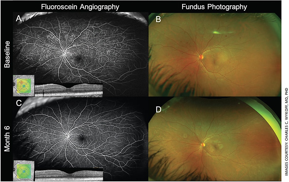 Figure 1. Widefield imaging from the ongoing prospective PRIME trial at baseline (A and B) and at month 6 (C and D). Images A and C: Widefield fluorescein angiography (WFFA) and OCT. B and D: Fundus photography. Between baseline and month 6, the patient received five intravitreal aflibercept injections in the study eye and improved two diabetic retinopathy severity scale (DRSS) steps, from DRSS 53 (severe NPDR) to DRSS 43 (moderate NPDR). Accordingly, most of the intraretinal hemorrhages have resolved, and the leakage index, a new biomarker reflective of extent of blood-retinal-barrier breakdown assessed by WFFA, has decreased from 6.42% to 0.04% at month 6. Images captured on the Heidelberg Spectralis HRA+OCT and Optos 200Tx.