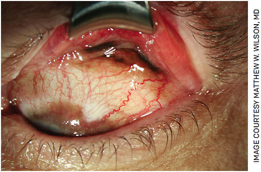 FIGURE 2. Slit lamp examination showed a double everted upper eyelid with pigment in the superior fornix.