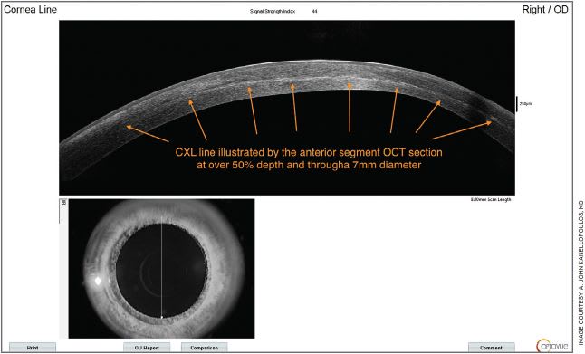 FIGURE 5. An anterior OCT corneal section with the Optovue OCT device. The CXL line pointed by the orange arrows confirms the effective deep (over 50% depth) and wide (this is a 9-mm section in diameter) CXL effect achieved in the case illustrated in Figure 4.