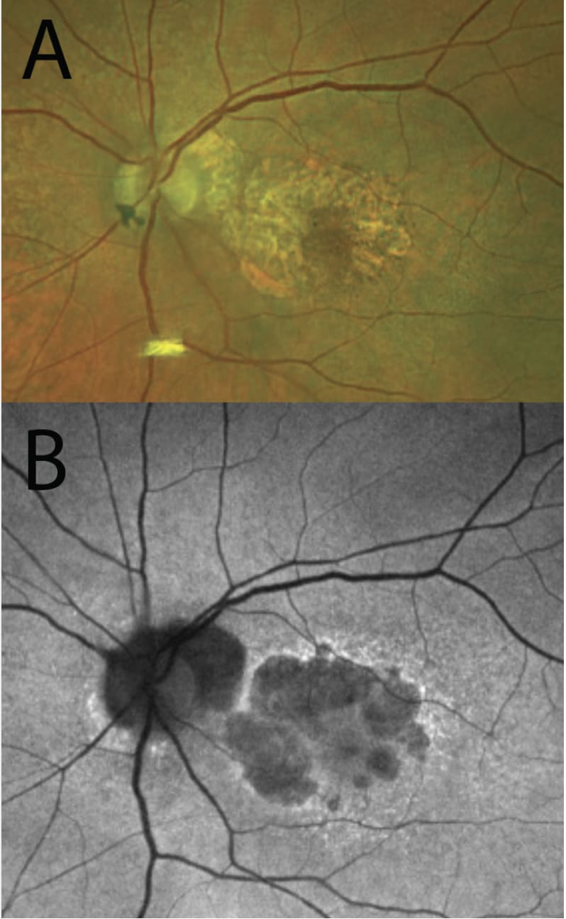 igure 1.  A. Color fundus photograph (Optos California) of patient with geographic atrophy. Note the border of the GA lesion can be difficult to delineate, especially inferiorly. B. Fundus autofluorescence (Optos California) of the same eye. The multifocal lesions at the inferotemporal macula are readily visualized as darker than the surrounding tissue. Note the fovea also appears dark but is not involved in the atrophy.