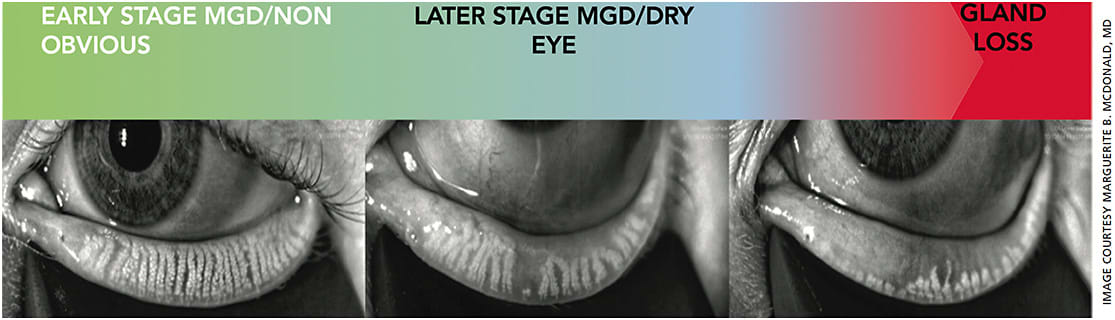 Figure. Meibomian gland imaging. Look for duct dilation, gland constipation, curling and shortening (atrophy), hazy appearance and dropout. This is a powerful tool to motivate patients to accept/perform preventive care.