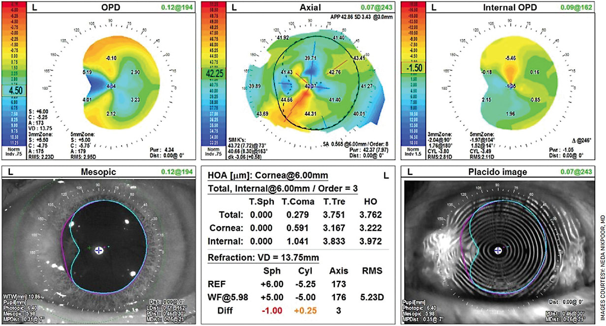 FIGURE 2. This placido disc image (OPD-Scan III, Nidek) clearly shows distortion of the nasal and central mires due to a nasal pterygium. This patient was referred for cataract surgery, and this image was very helpful in explaining why I recommended pterygium surgery to improve the ocular surface prior to cataract surgery. Her corneal total coma is 0.591, which is higher than recommended for diffractive IOLs, and this patient was interested in reducing her dependence on glasses and contacts. Pterygium surgery can often improve the regularity of the cornea in these cases and enable patients to choose from more IOL options.