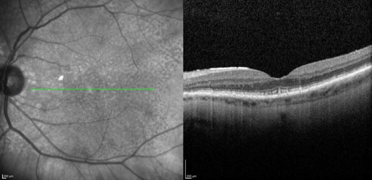 Figure 4. Infrared (left) and OCT (right) demonstrating reticular pseudodrusen. Imaging via Heidelberg Spectralis.