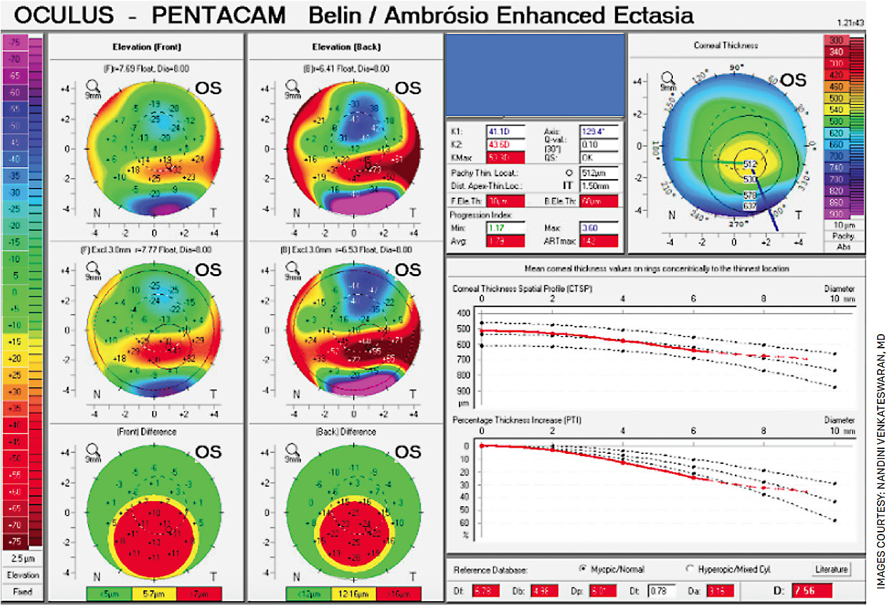 FIGURE 1. Belin/Ambrósio Enhanced Ectasia display showing significant posterior corneal elevation, an elevated D-score and inferotemporal displacement of the thinnest point consistent with keratoconus.