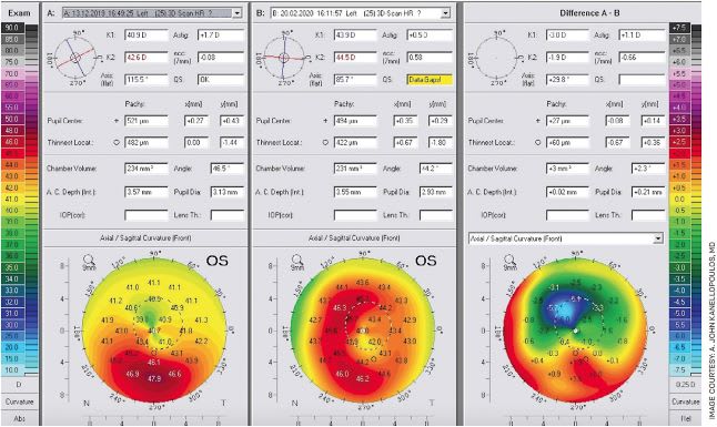 FIGURE 4. The pre- to post-CXL treatment for keratoconus with the Athens Protocol (combined topography-guided excimer ablation normalization with accelerated CXL at 6 mW/cm2).