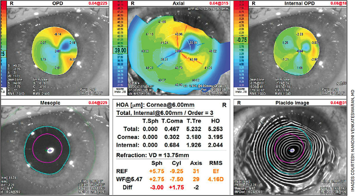 FIGURE 2. NIDEK OPD-Scan III topographer showing altered placido disc mires nasally along with superonasal flattening characteristic of a Salzmann’s nodule on corneal exam.