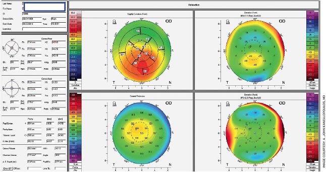 FIGURE 3. Does this post-LASIK case demonstrate ectasia?