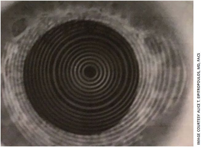 Figure 3B. The patient’s corneal irregularities improved following use of topical steroids and immunomodulators, artificial tears and re-esterified omega-3 fatty acid supplements, as well as epithelial debridement and phototherapeutic keratectomy and application of an artificial membrane.