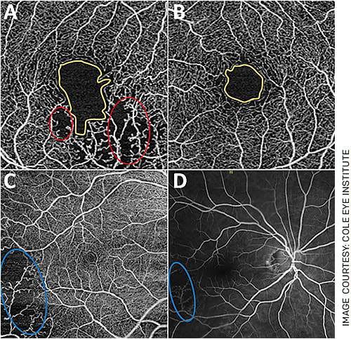 FIGURE 3. OCTA changes in branched retinal vein occlusions (BRVO).