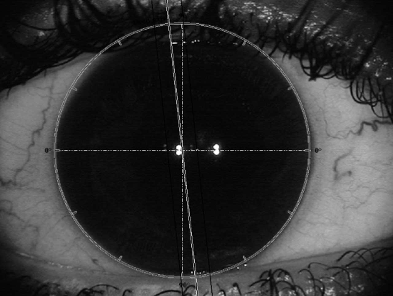 CALLISTO reference image is taken at the time of IOLMaster biometry. Limbal conjunctival vessels are used to account for torsion and guide toric lens placement.