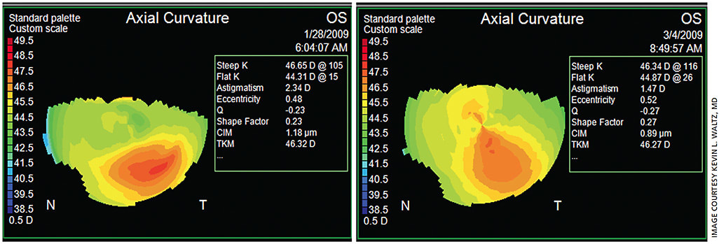 Figure 1. Left image is first preop topography. Note the date is Jan. 28. Right image is second preop after 33 days of AT QID. Note the date is March 4. There has been an 11° shift in axis and a 0.9-D power shift with treating the dry eye for a month. Topography images via the Zeiss Atlas.