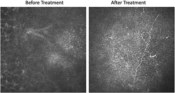 Figure 3. In vivo confocal microscopy demonstrating nerve regrowth before (left) and after (right) 8 weeks of Oxervate therapy.