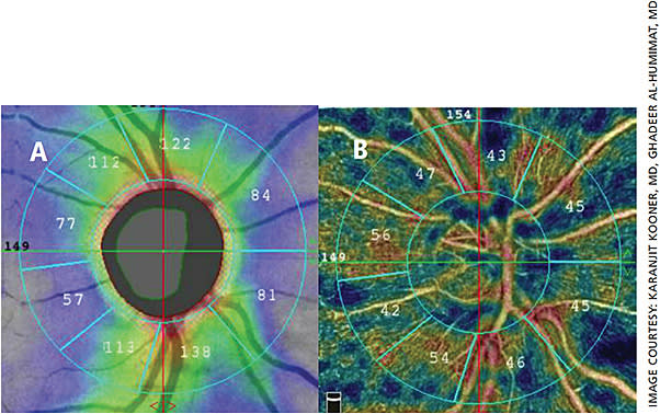 Figure 2. A 71-year-old black female with mild glaucoma. A. Average peripapillary nerve fiber layer thickness = 98 µ. B. Circumpapillary vessel density 47%.