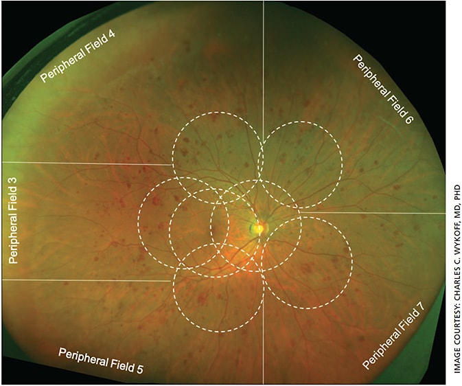 Figure 2. Widefield fundus photography of an eye with a diabetic retinopathy severity scale (DRSS) of 53 with PPLs from the ongoing Phase 2 PRIME trial. White dotted circles indicate superimposed ETDRS standard seven-field photography locations; solid white lines delineate the corresponding peripheral fields. These delineations are approximate and not meant to be exact. This eye contains PPLs in all graded fields (3-7), with greater than 50% of the hemorrhages/microaneurysms in each field being located outside of the standard ETDRS fields. The presence of PPLs is an important prognostic indicator suggesting a higher risk of disease progression and is being studied prospectively in the ongoing DRCR Protocol AA. Image captured on the Optos 200Tx.