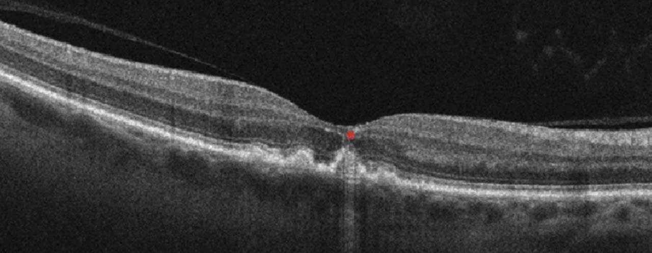 Figure 2. Incomplete RPE and outer retinal atrophy (iRORA) indicated by asterisk. Imaging via Zeiss Cirrus 5000.