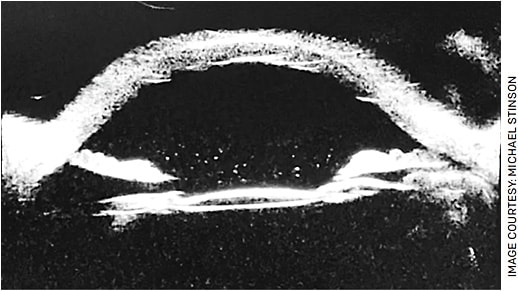 FIGURE 3. UBM image demonstrating a tilted PC IOL OD.