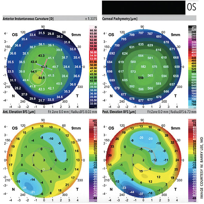 Figure 2. Galilei topographic image of a left eye with subclinical keratoconus. Anterior instantaneous curvature and anterior elevation maps show no abnormalities. Posterior elevation map shows an abnormal elevation of 15 microns within the 3-mm zone.