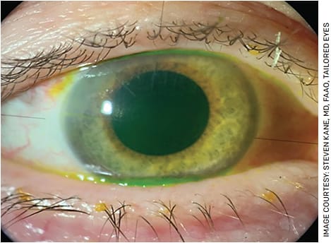 FIGURE 3. Slit lamp color photos of a patient with 14 cut RK postop day 1 after cataract surgery with a Light Adjustable Lens implant.