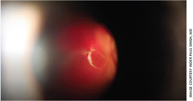 Figure 2. A view of a Weiss ring through the slit lamp attached to a YAG vitreolysis laser.