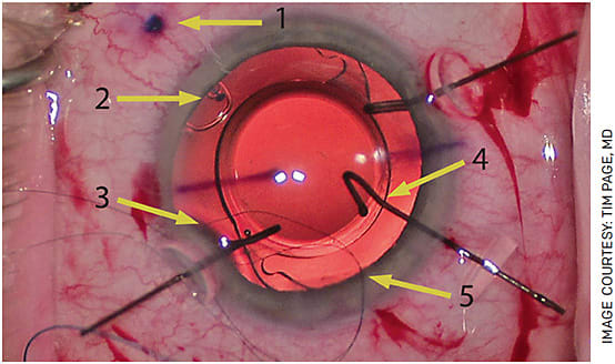 FIGURE 6. This eye looked similar to Figure 5 when I started. The capsular bag had very little to no support. Extra OVD was used to tamponade the vitreous, a 6-0 polypropylene rivet (Arrow 1) was used to secure a capsular tension segment (Arrow 2) in place. A standard CTR with the suture-guided technique was used for additional support (Arrow 3). Capsular hooks were used to support the capsule during insertion of the CTS and CTR (Arrow 4).