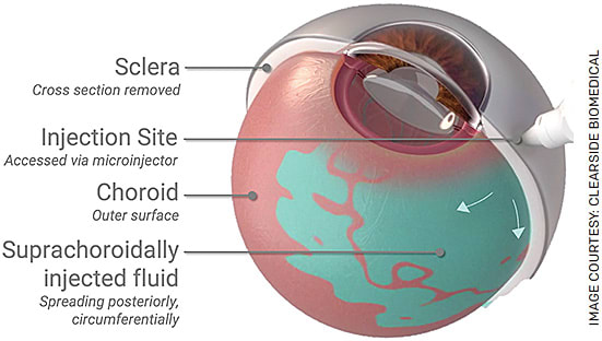 FIGURE. Suprachoroidal injection via a microneedle. Fluid enters the suprachoroidal space, the potential space between the choroid and sclera