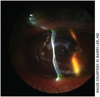 FIGURE 1. Slit lamp photo showing marked keratolysis following delayed epithelial healing after epi-off crosslinking