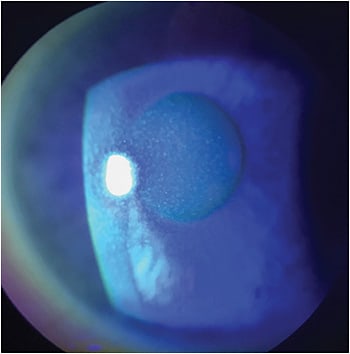 Figure 1. Stage 1 NK. Slit lamp photograph of a punctate keratitis in a neurotrophic cornea secondary to advanced diabetes mellitus.