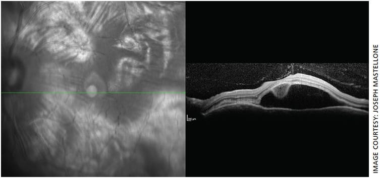 Figure 2. OCT macula of the left eye demonstrating a large amount of subretinal fluid consistent with serous (exudative) retinal detachment.