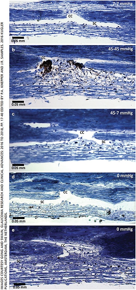 Figure 2: Narrowing or collapse of Schlemm’s canal (SC) and herniation into the CC ostia with increased IOP in normal human eyes and in POAG eye. a: When a normal human eye was continually perfused at 7 mm Hg (normal IOP for an enucleated eye without episcleral venous pressure), SC was open and no herniation into the CC ostium was visible. b: When the eye was continually perfused at 45 mm Hg, SC was collapsed and the TM was herniated into the CC ostium. c: The eye was first perfused at 45 mm Hg, followed by a reduction to 7 mm Hg. Lowering the pressure reversed the herniation that was seen at 45 mm Hg. Only deformation of the TM was seen facing the CC ostium region. SC was wider in this eye than in the one perfused continuously at 45 mm Hg (b). d: When a normal eye fixed at 0 mm Hg, SC was open and the herniation was not visible at the CC ostium. e: In comparison, when an eye with POAG was fixed at 0 mm Hg, a collapse of SC adjacent to both sides of CC ostium with focal adhesions between the inner wall and outer wall of SC and herniations of the inner wall and JCT into CC ostia were observed.