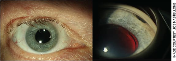 FIGURE 1. A. Slit lamp photo of the right eye is grossly normal. B. Gonioscopy examination of the inferior angle OD showed inferior iridodialysis with PAS on either side.