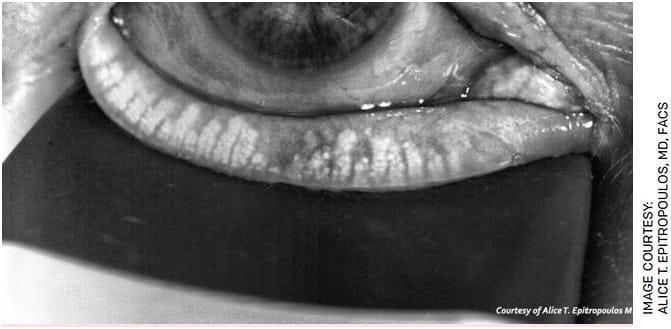 FIGURE 2. MGD with gland dropout and atrophy