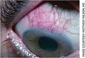 FIGURE 4. Rose bengal dye revealing superior bulbar conjunctival erosions