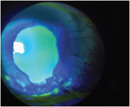 Figure 2. Stage 2 NK. Slit lamp photo of a neurotrophic corneal ulcer with fluorescein uptake and staining using a cobalt blue light filter.