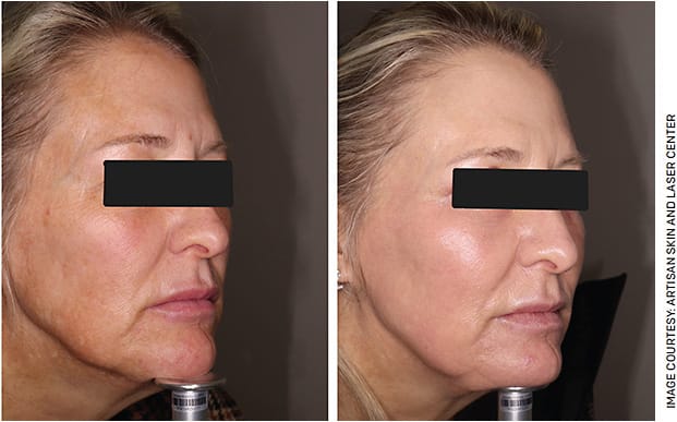 A patient before (left) and after (right) bilateral upper lid blepharoplasty, Ultra Laser Peel Eyes and Halo Laser Face procedures.