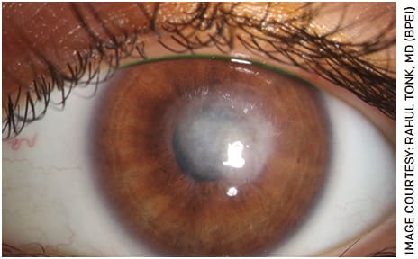 FIGURE 4. Slit lamp photograph demonstrating central corneal scar after 7 months of topical dual therapy with PHMB and propamidine isethionate (0.1%) (Brolene, Sanofi) for Acanthamoeba keratitis