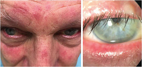 Figure 1. Left: the patient’s significant papulopustular rosacea, prior to first IPL treatment. Note the redness of the eyelid margins as well as the facial manifestations. Right: slit lamp photo from the same time — note significant lid thickening, MGD and conjunctival injection.